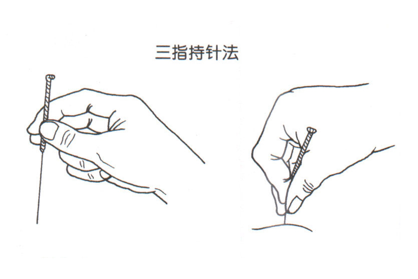 單式針刺手法 單式針刺手法