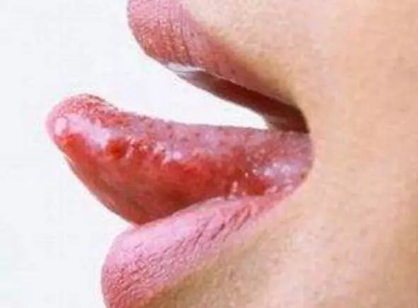 舌咬傷