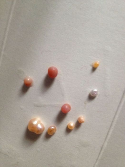 血珍珠 血珍珠