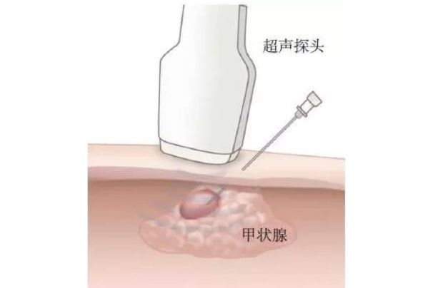 FNA(診療手段) FNA(診療手段)