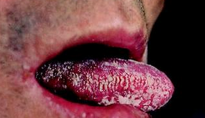 口腔念珠菌感染