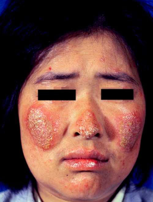 亞急性皮膚型紅斑狼瘡