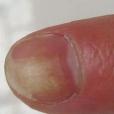 食指指甲凹陷
