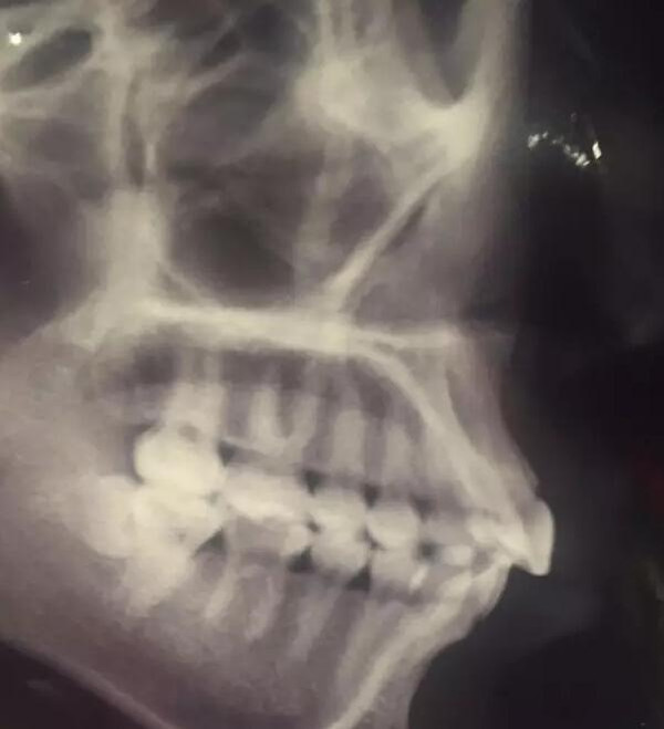 牙槽骨突出