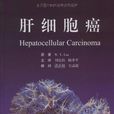肝細胞癌 肝細胞癌