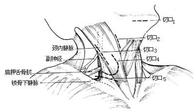 頸部淋巴結切除術的各種切口