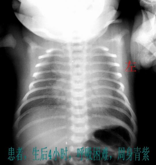 新生兒肺透明膜病X線表現