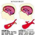 缺血性腦中風 缺血性腦中風
