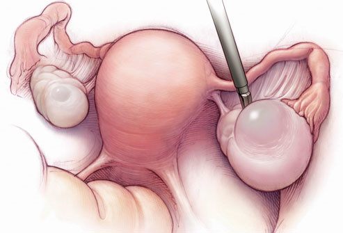 卵巢發育不全性不孕