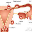 宮外孕：可以防範於未然