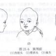 短頭畸形 短頭畸形