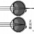 高度遠視眼 高度遠視眼