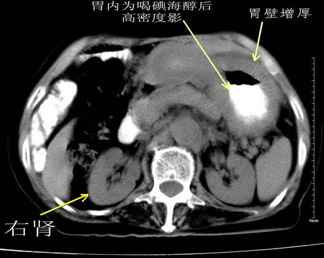 皮革胃CT上腹部橫斷面圖片