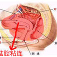 盆腔粘連 盆腔粘連