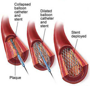 心臟支架 - 構造