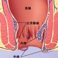 內痔瘡 內痔瘡