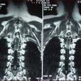 脊髓髓內腫瘤切除術