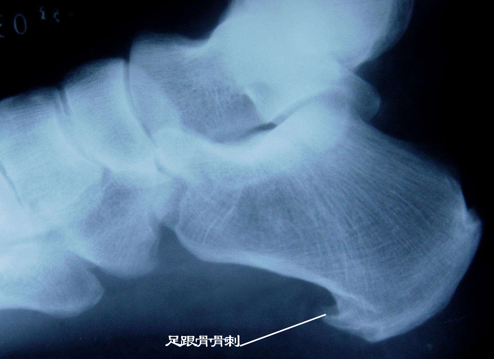足跟骨骨刺X線表現