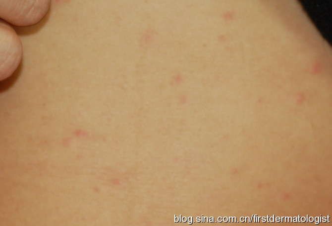 人被感染表現為皮膚紅斑紅疹