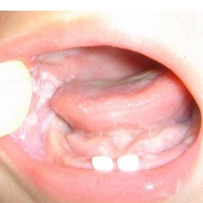 口腔黏膜上白色較硬的隆起斑塊