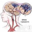 缺血性中風 缺血性中風