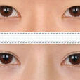 韓式雙眼皮整形術