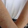 雞皮病 雞皮病