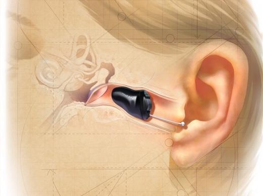 超小型助聽器