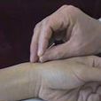毫針療法 毫針療法