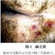 尾部中線有細小凹坑但無任何感覺 尾部中線有細小凹坑但無任何感覺