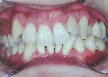 圖2玻璃纖維牙周夾板固定下前牙