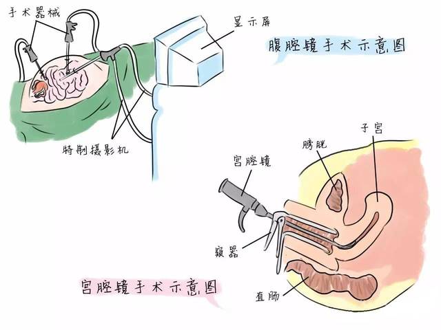 宮腔鏡手術