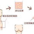 自體脂肪豐胸