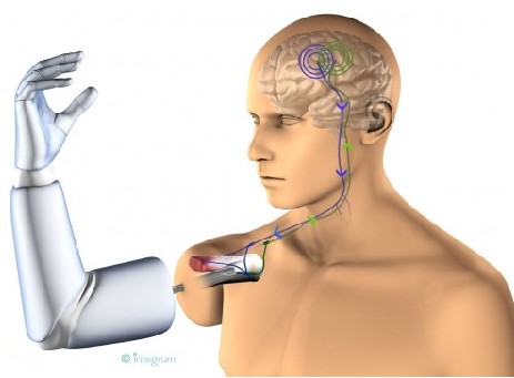 意念控制植入式醫療機器人手臂