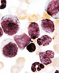 毛細胞性白血病(圖7)