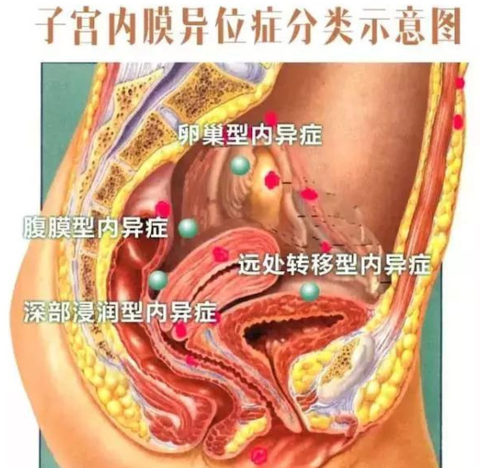 盆腔子宮內膜異位半保守性手術