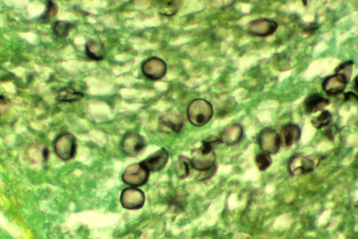 卡氏肺孢子菌