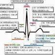 心電圖U波 心電圖U波