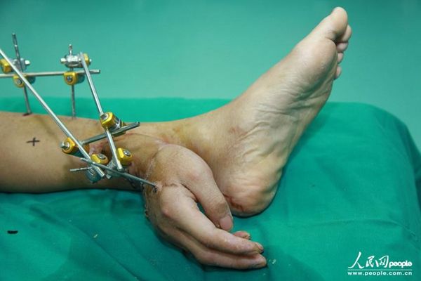 腳踝斷手 腳踝斷手