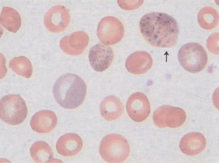 嗜鹼性點彩紅細胞(點彩紅細胞)
