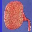 免疫性腎病 免疫性腎病