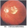 變性近視脈絡膜萎縮