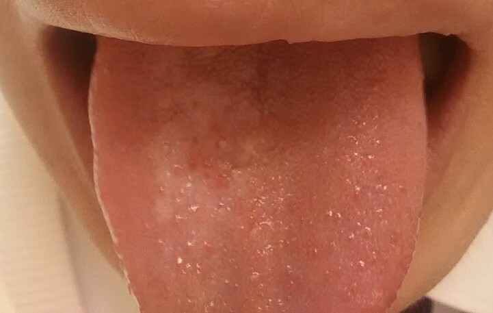 舌乳頭