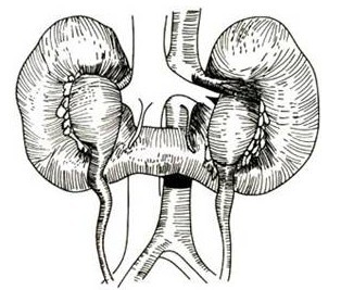 馬蹄形腎