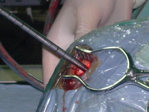 腦室鏡 腦室鏡
