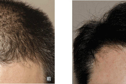 隱形補發 隱形補發