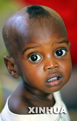 肯亞一名營養不良的男孩坐在醫院病床上