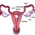 輸卵管宮外孕
