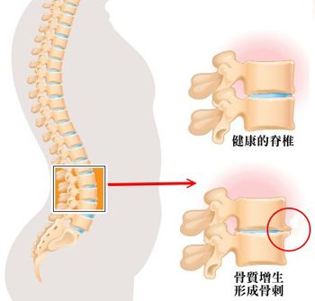 腰骨增生 腰骨增生