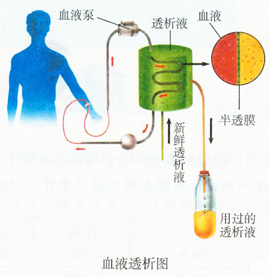 血液透析圖
